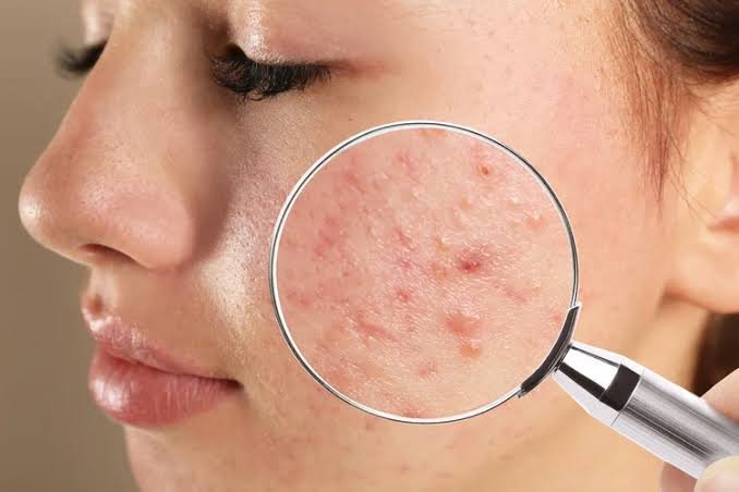 Acne and Pimples Clinical Treatment